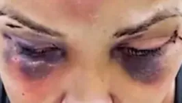 A mulher teve  traumatismo craniano, fratura na mandíbula e diversos hematomas pelo corpo.