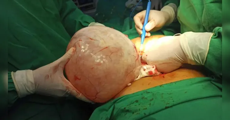 Imagem ilustrativa da notícia Médicos retiram cisto de 5 kg do ovário de idosa, no Piauí