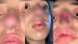 Imagem ilustrativa da notícia Jovem fica com o nariz necrosado após procedimento estético