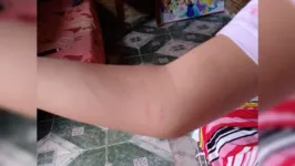 Foto mostra arranhões no braço da aluna agredida.