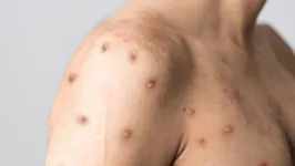 Os doentes com varíola dos macacos desenvolvem uma erupção na pele que pode formar bolhas