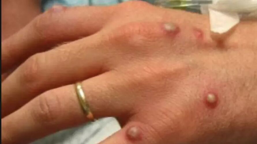 Os doentes com varíola dos macacos desenvolvem uma erupção na pele que pode formar bolhas