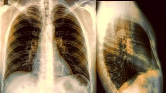 Imagem ilustrativa da notícia Câncer de pulmão também pode atingir não fumantes