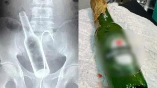 Imagem ilustrativa da notícia Acre: homem passa por cirurgia para retirar garrafa do ânus 