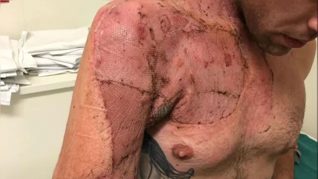Imagem ilustrativa da notícia Atleta tem braço amputado após sofrer com bactéria 