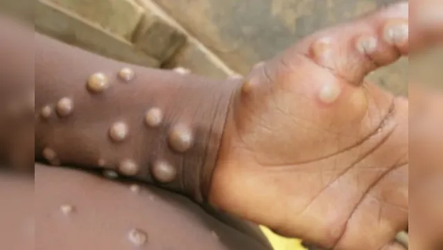 Imagem ilustrativa da notícia Criada comissão para acompanhar casos de varíola dos macacos