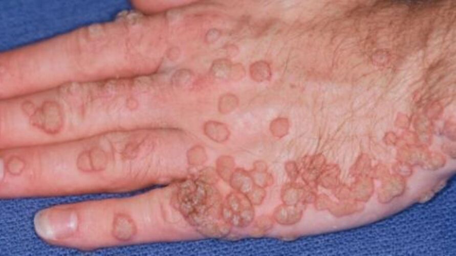 A varíola dos macacos é caracterizada por sintomas de febre, bem como uma erupção cutânea.
