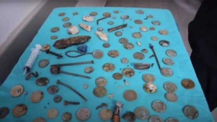 Imagem ilustrativa da notícia Vidro, moeda e prego: homem tinha 233 objetos no estômago