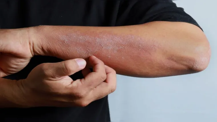 Imagem ilustrativa da notícia Conheça 6 sinais na pele que podem indicar diabetes