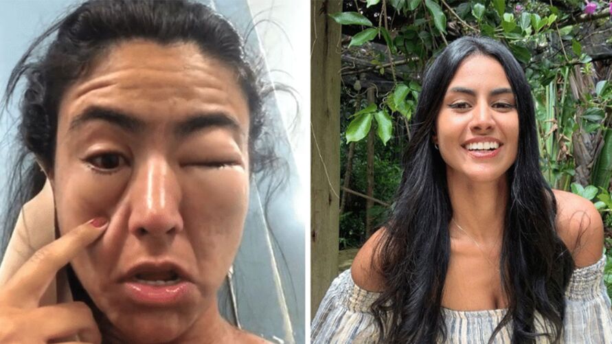 Amanda Nicândio, de 22 anos, teve uma forte reação alérgica a camarão