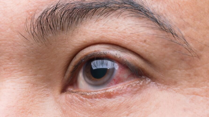Maio Verde marca preven&#231;&#227;o e combate ao glaucoma