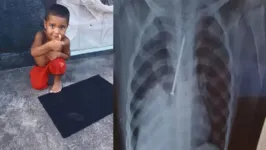 Exame de raio-X DE Cauan Araújo Conceição, de apenas 3 anos.