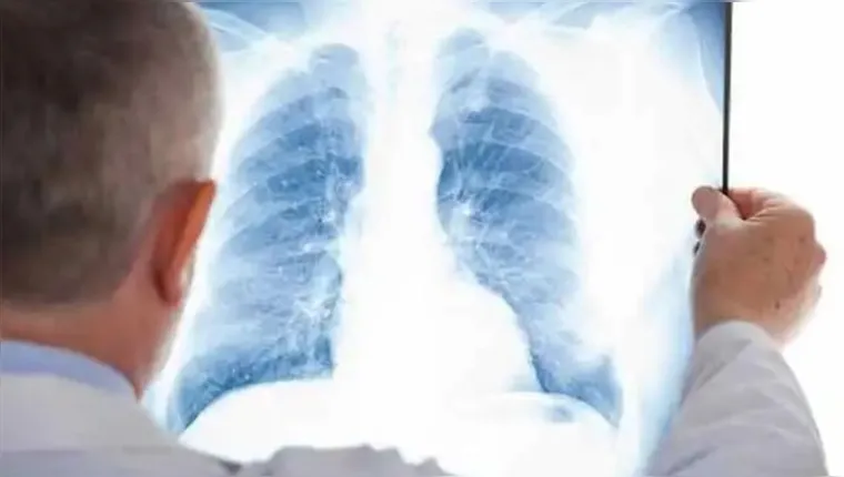 Imagem ilustrativa da notícia Internações por embolia pulmonar cresce 40% no Brasil