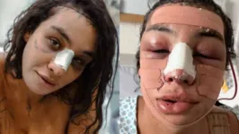 Linn da Quebrada passou por cirurgia e compartilhou imagens nas redes sociais
