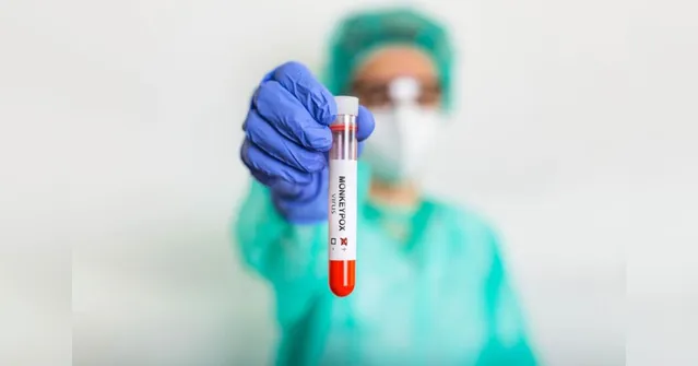 Imagem ilustrativa da notícia Varíola dos macacos: Anvisa cria comitê técnico emergencial