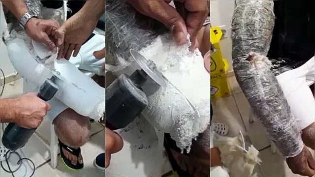 Imagem ilustrativa da notícia Vídeo: preso com droga escondida em braço engessado 