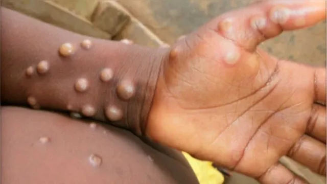 Imagem ilustrativa da notícia Paragominas
e Bragança monitoram casos suspeitos da varíola