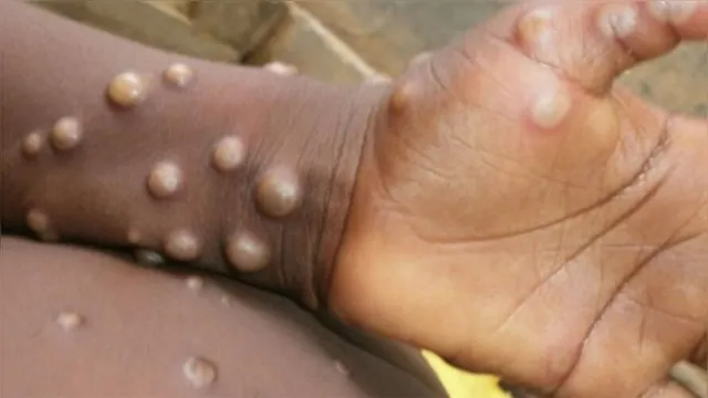 Imagem ilustrativa da notícia Japão emite alerta para surto de varíola dos macacos