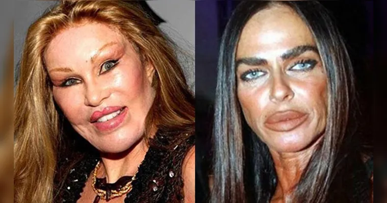 Imagem ilustrativa da notícia 10 famosas com os rostos deformados por cirurgia plástica