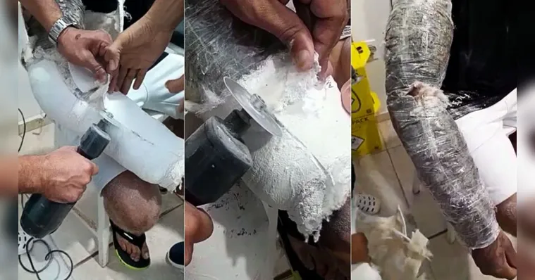 Imagem ilustrativa da notícia Vídeo: preso com droga escondida em braço engessado 