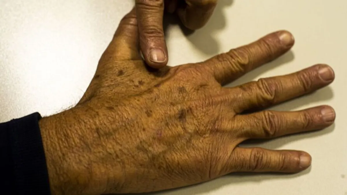 Imagem ilustrativa da notícia Filtro solar não evita câncer de pele que atinge mais negros 