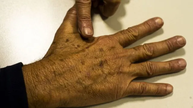 Imagem ilustrativa da notícia Filtro solar não evita câncer de pele que atinge mais negros 