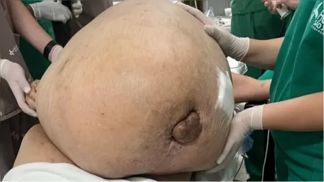 Imagem ilustrativa da notícia Médicos retiram tumor de 46 Kg de mulher no Rio 