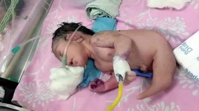 Imagem ilustrativa da notícia Síndrome rara: Bebê nasce com 'rabo de sereia'