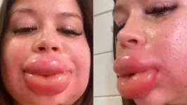 Karli Gardner viveu um pesadelo ao ver seus lábios dobrarem de tamanho após ter uma reação alérgica ao ácido hialurônico