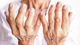 A artrite é uma das doenças autoimunes mais comuns