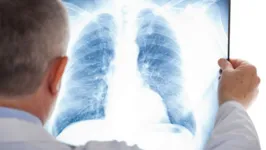 Imagem ilustrativa da notícia Tuberculose matou 1,6 milhão de pessoas no mundo em 2021