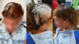 A vítima compartilhou nas redes sociais as fotos de como seu cabelo ficou após o sequestro.