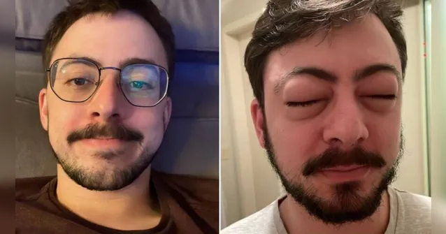 Imagem ilustrativa da notícia Alergia deixa médico deformado e iPhone não reconhece rosto
