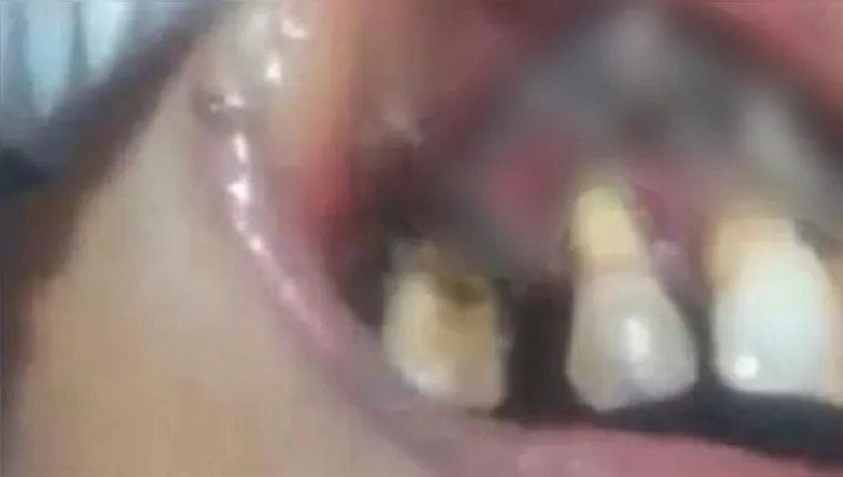 Imagem ilustrativa da notícia TO: paciente tem 130 larvas na boca e hospital é investigado