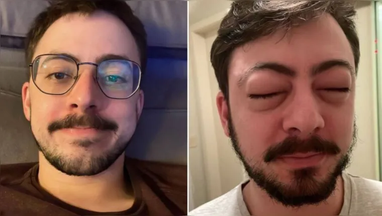 Imagem ilustrativa da notícia Alergia deixa médico deformado e iPhone não reconhece rosto