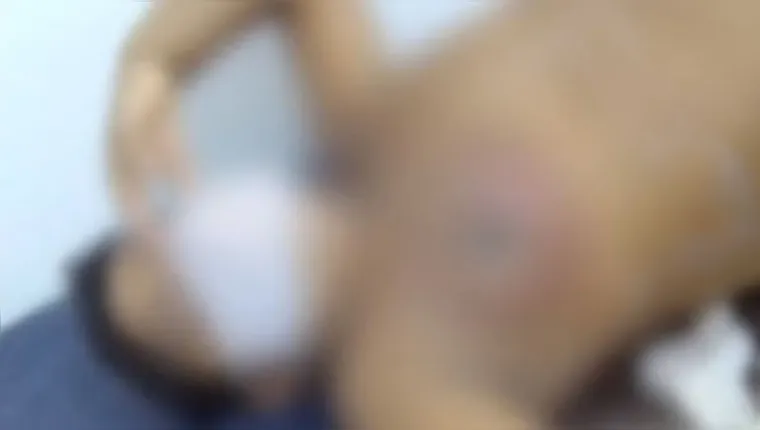 Imagem ilustrativa da notícia Vídeo:
menino tem parte do peito arrancado por cavalo