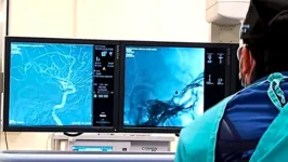 Setor de hemodinâmica já realizou 415 procedimentos cirúrgicos cerebrais de alta complexidade