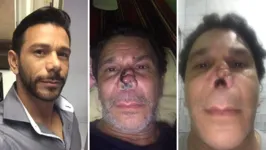 João Rosivaldo Farias da Silva antes e depois das quatro cirurgias