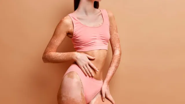Imagem ilustrativa da notícia Tire suas dúvidas: dermatologista dá detalhes sobre vitiligo