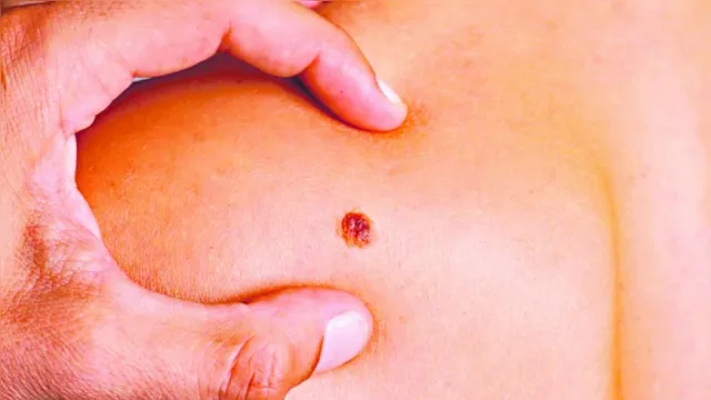 Imagem ilustrativa da notícia Campanha faz alerta contra o câncer de pele