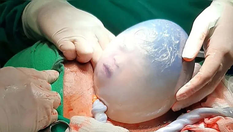 Imagem ilustrativa da notícia Muito raro: parto de gêmeas tem uma bebê empelicada no Pará