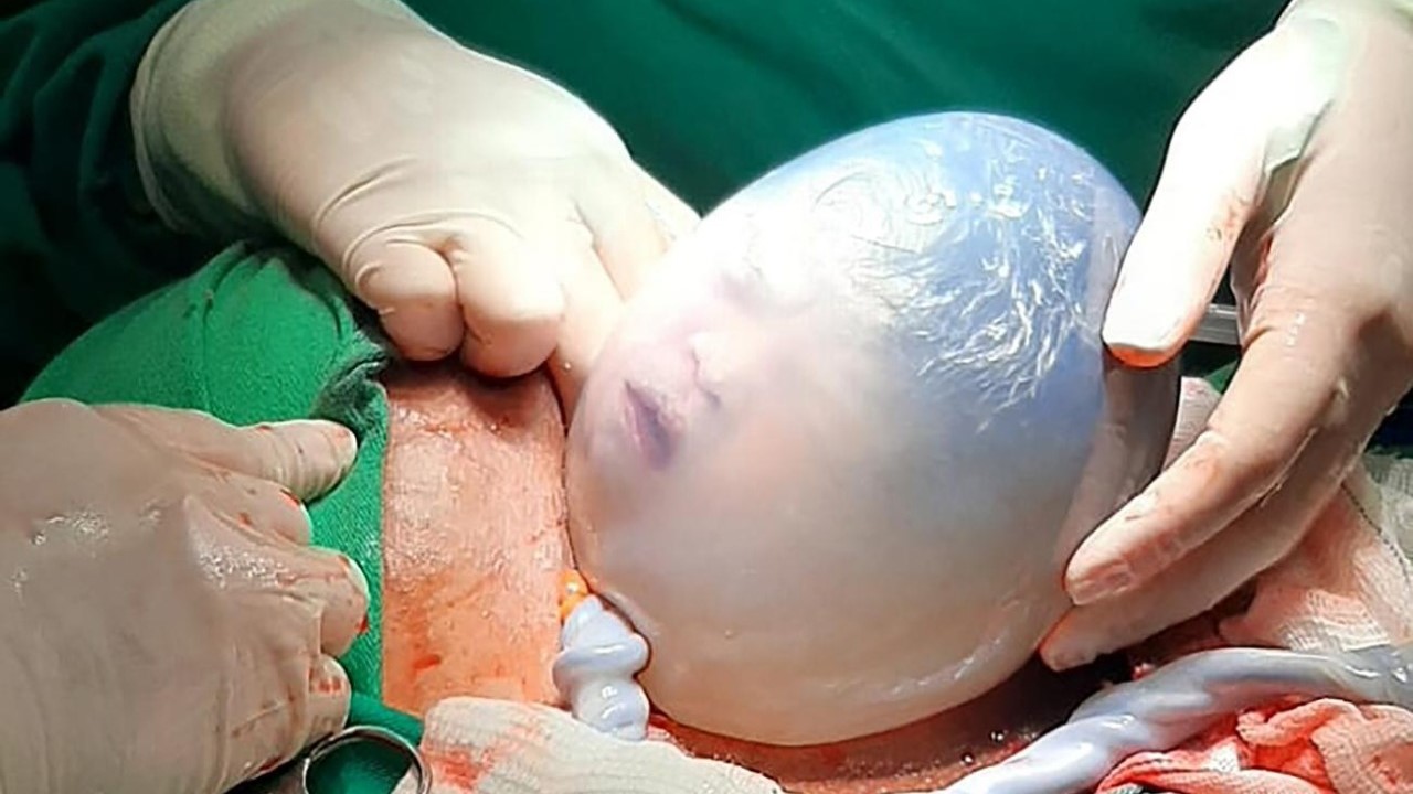 Muito raro: parto de gêmeas tem uma bebê empelicada no Pará