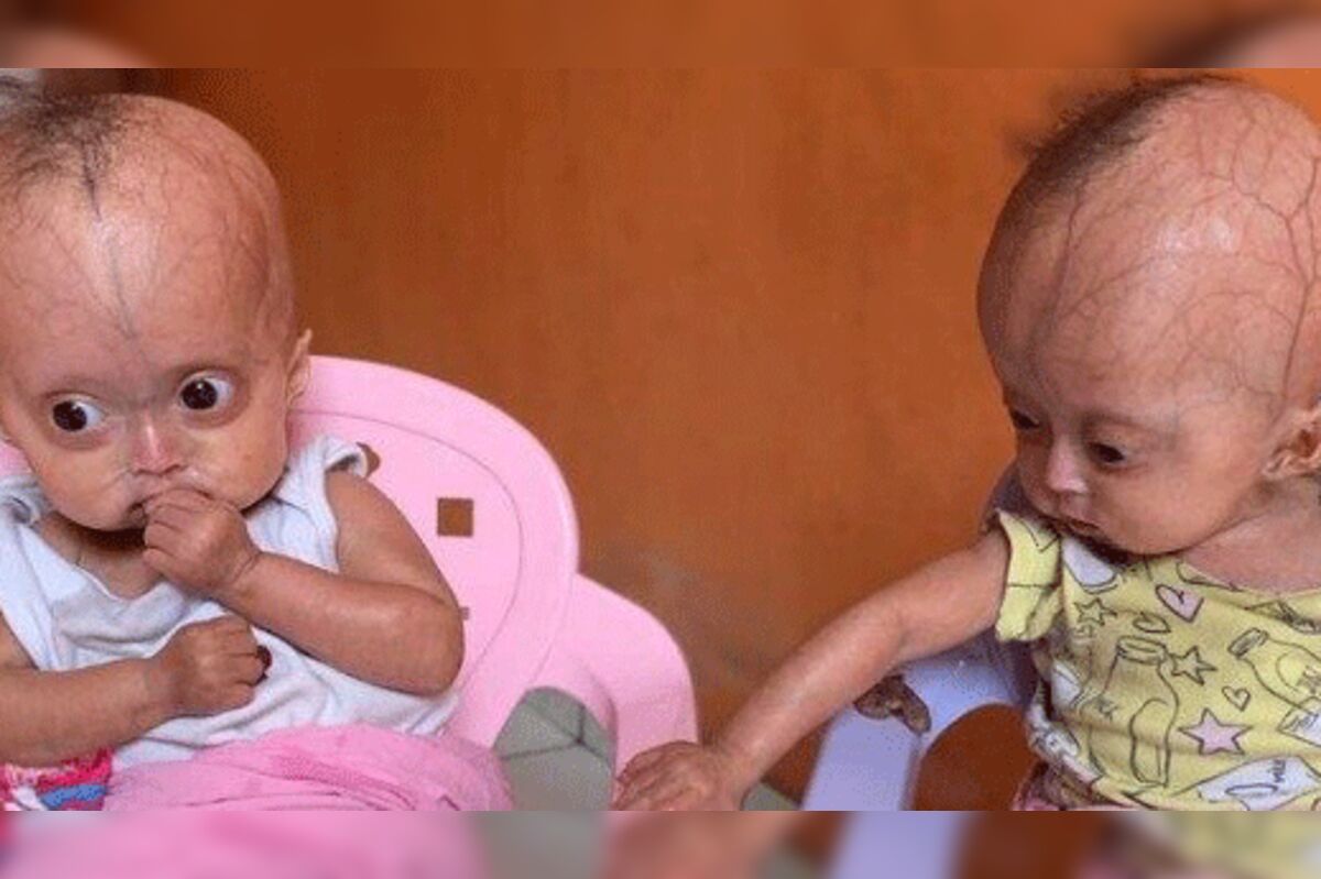 Domingo Espetacular on X: As gêmeas idênticas Elis e Eloá sofrem de uma  síndrome rara que acelera o envelhecimento em até sete vezes. Isso significa  que quando a criança atinge os dez