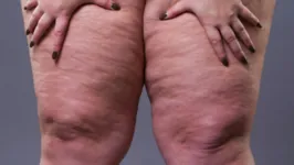 O lipedema atinge principalmente mulheres.