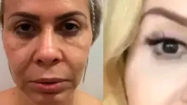 Resultado de harmonização facial de Joelma deixou todos chocados