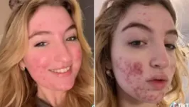 Eva Grant mostra conteúdo sobre acne