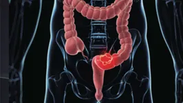 No câncer de intestino o diagnóstico é feito geralmente através do exame histopatológico