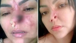 Elielma Carvalho que perdeu parte do nariz após passar por procedimento com dentista em Aparecida de Goiânia (GO)