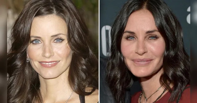 Imagem ilustrativa da notícia Atriz de Friends diz que errou com preenchimentos faciais
