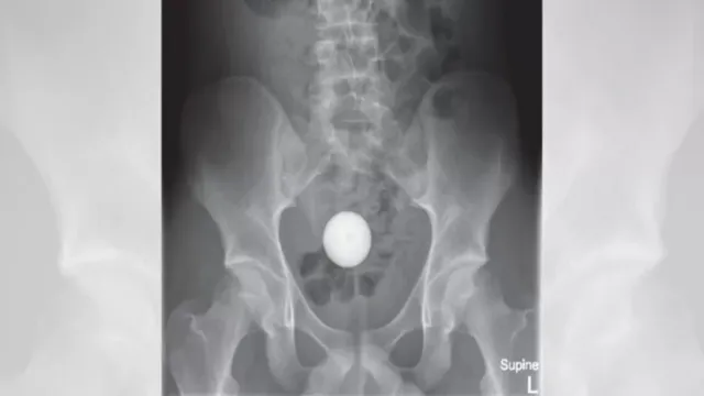 Imagem ilustrativa da notícia Jovem coloca bola no ânus e médicos lhe dão 1L de laxante